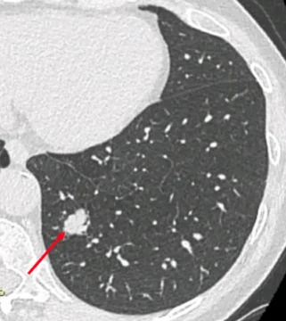 Nodule pulmonaire de nature indéterminée nécessitant des investigations à visée diagnostique.