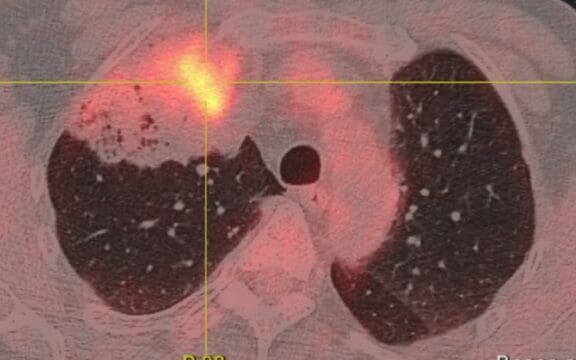 Dépistage généralisé du cancer du poumon d’ici 2030 : Nice et l’IHU RespirERA au cœur de l’innovation en santé respiratoire.
