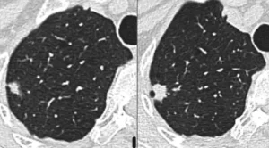 Nodule pulmonaire dont la croissance oriente vers sa nature maligne.